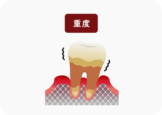 重度の歯周炎