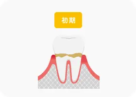 歯肉炎