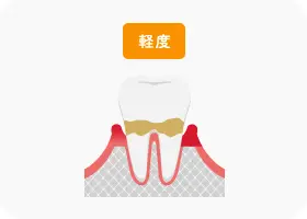 軽度歯周炎