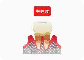 中等度歯周炎