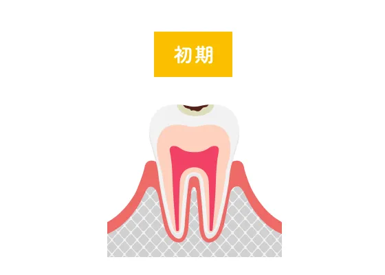 虫歯初期
