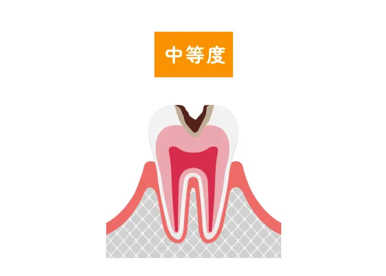 中等度の虫歯