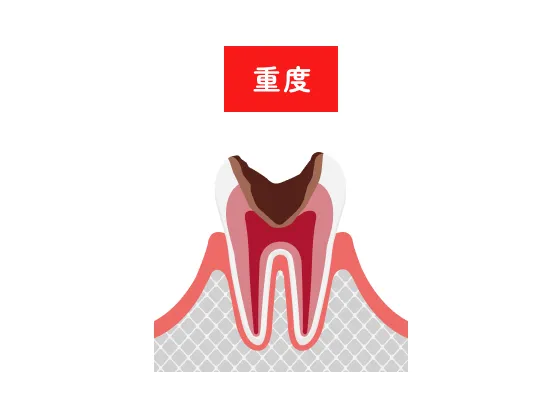 重度の虫歯