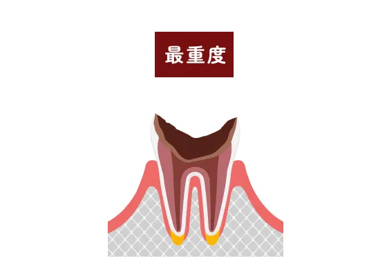 最重度の虫歯